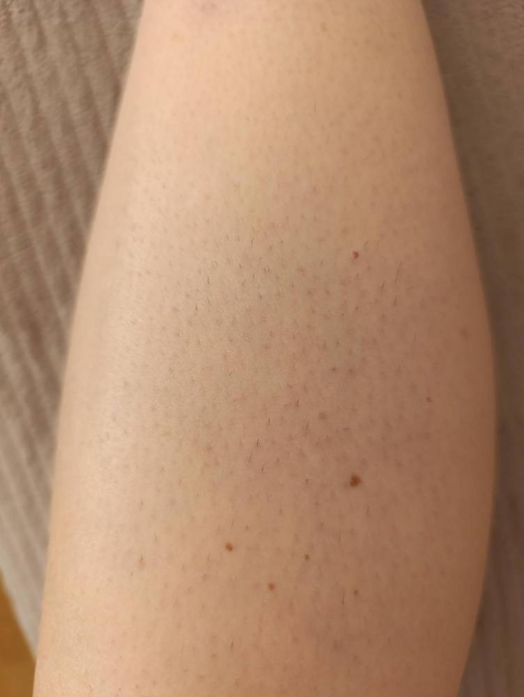 ox_caloroczna-bezbolesna-depilacja-laserowa-bez-wychodzenia-z-domu
